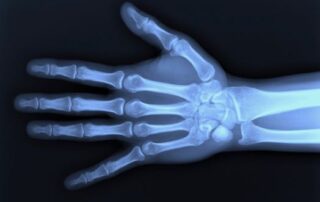 röntgen-hand